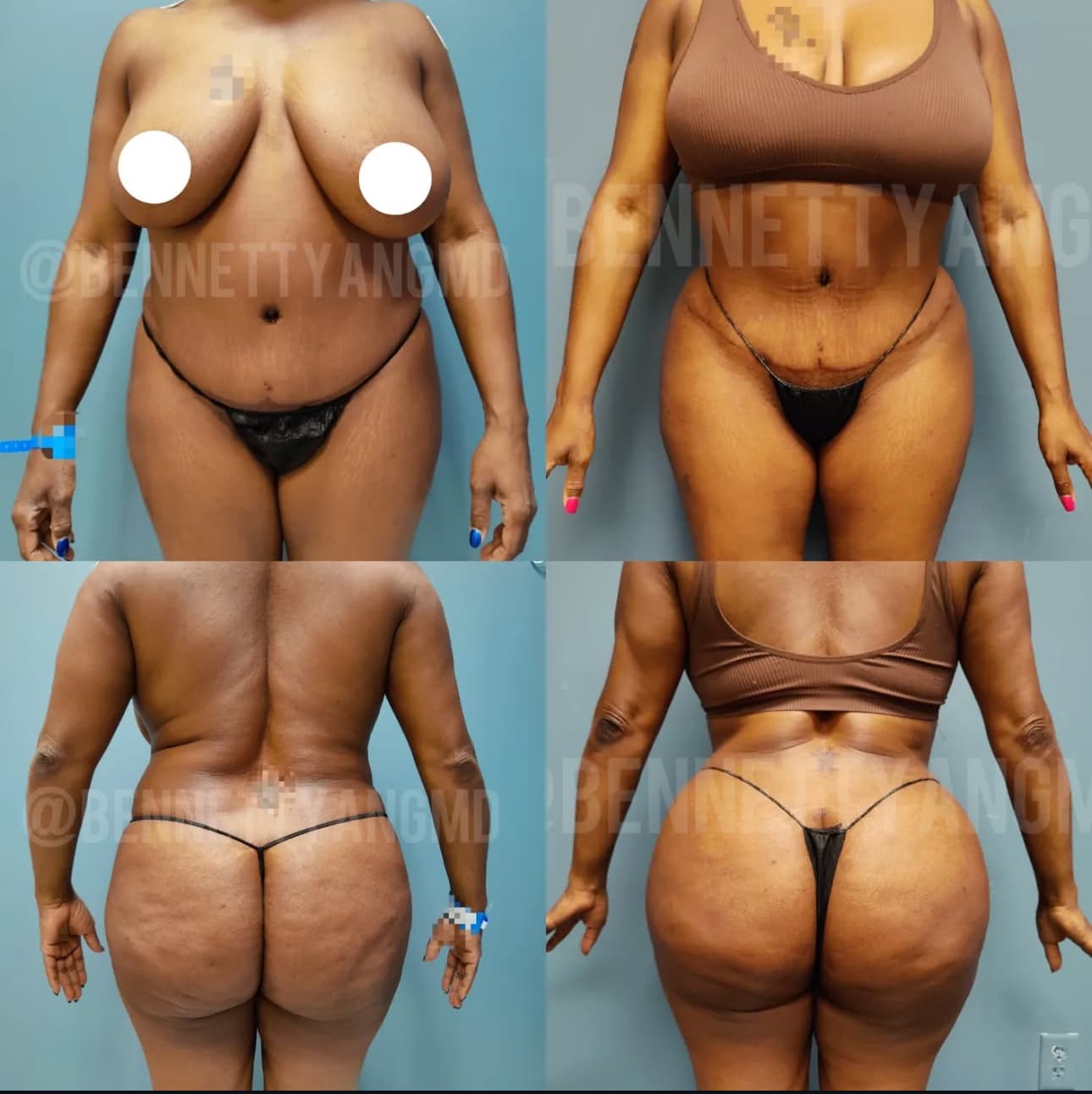 Before and after body contouring
result