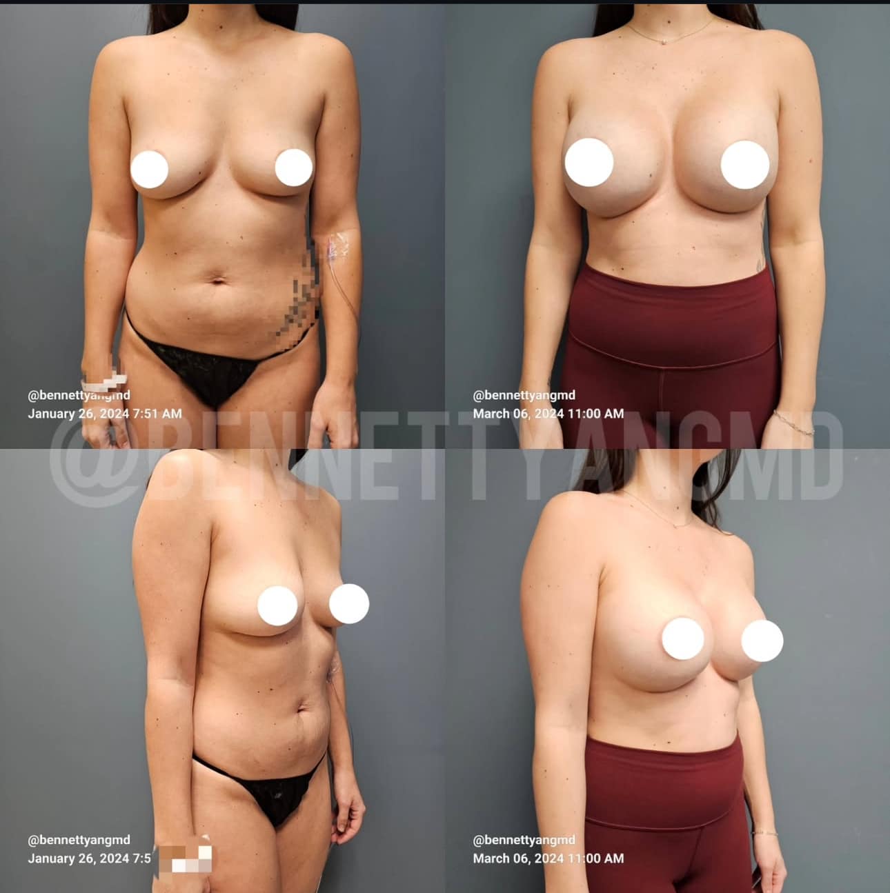 Before and after breast surgery
result