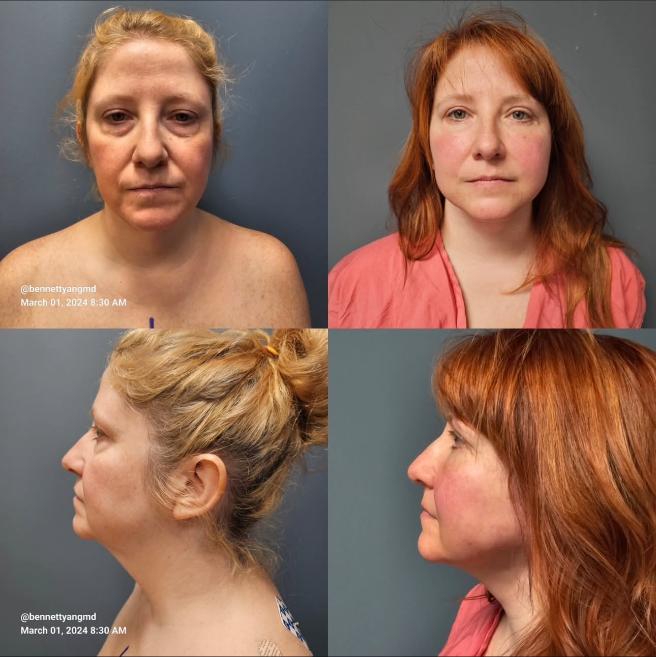 Before and after facial rejuvenation
result
