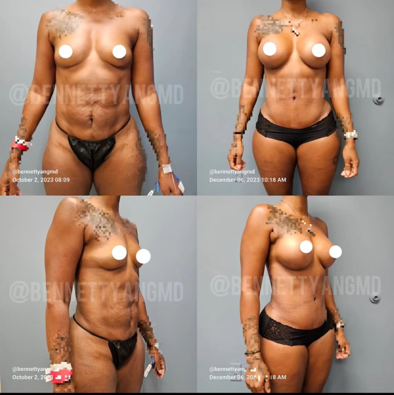 Before and after liposuction result